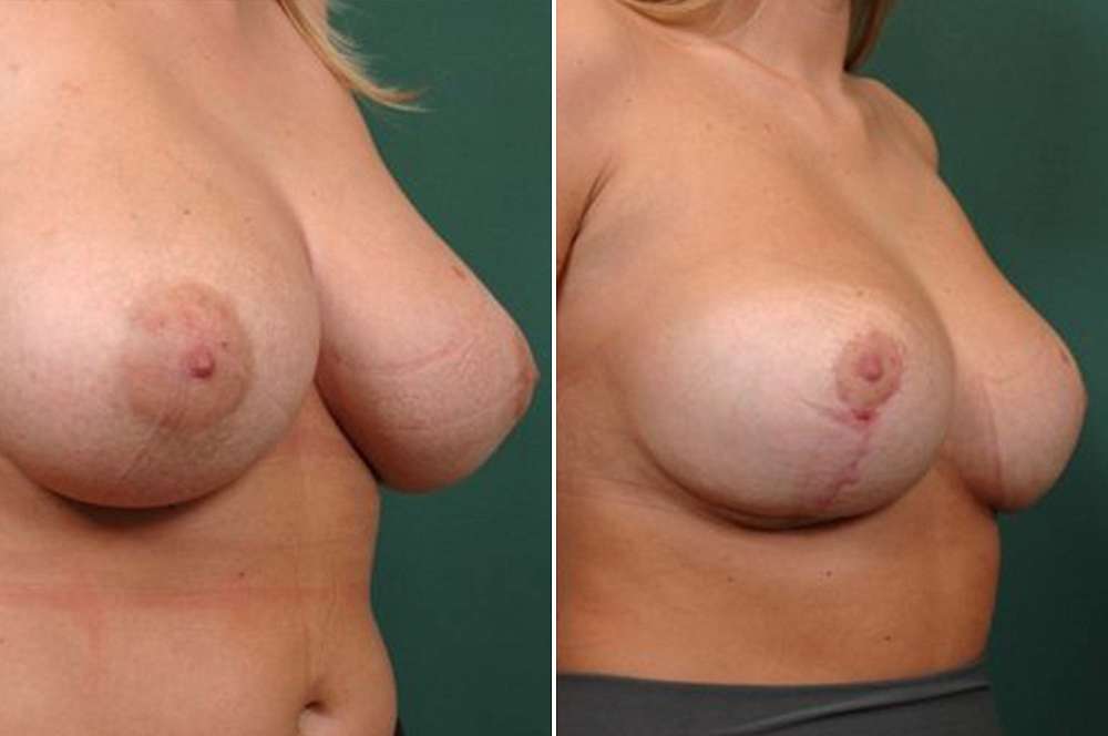 Breast Reduction - Body surgery
