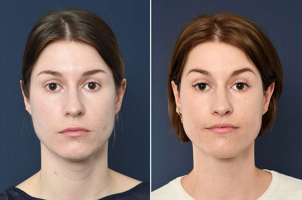 Lip lift - Facial surgery