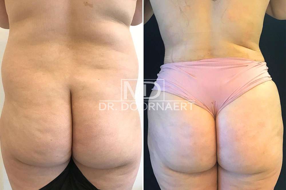 Hip and butt augmentation - Body surgery
