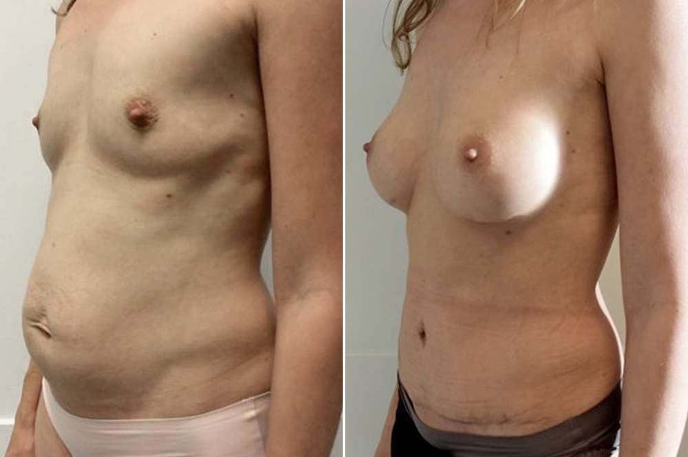Mommy makeover - Body surgery