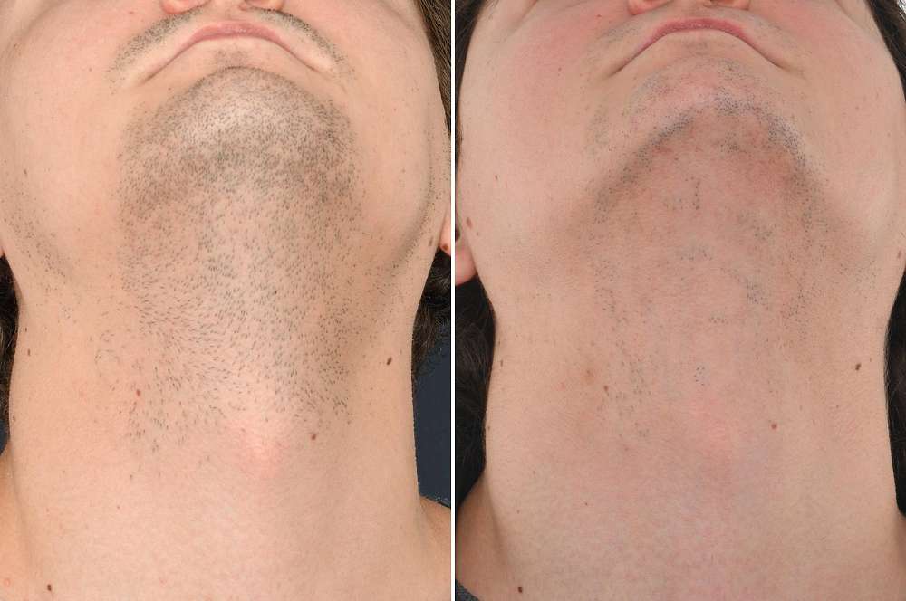 Laser hair removal - Hair removal